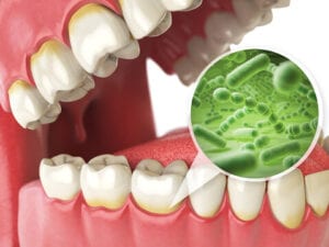 bacteria in gums